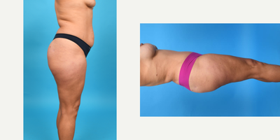 Case 1426 - 35-44 year old woman treated with Abdominal Etching, Belly Button Surgery, Diastasis Recti Repair, Drainless Tummy Tuck, Liposcu