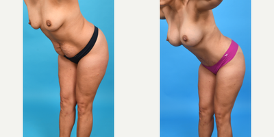 Case 1427 - 35-44 year old woman treated with Abdominal Etching, Belly Button Surgery, Diastasis Recti Repair, Drainless Tummy Tuck, Liposcu