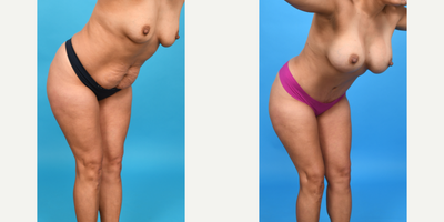 Case 1428 - 35-44 year old woman treated with Abdominal Etching, Belly Button Surgery, Diastasis Recti Repair, Drainless Tummy Tuck, Liposcu