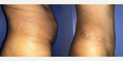 Case 1430 - Woman treated with Tummy Tuck