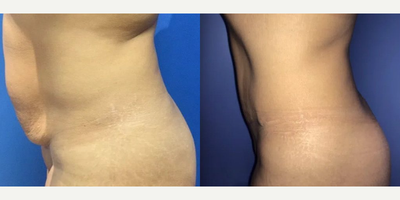 Case 1431 - Woman treated with Tummy Tuck