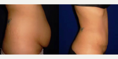 Case 1432 - Woman treated with Tummy Tuck