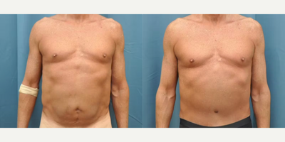 Case 144 - 65-74 year old man treated with Tummy Tuck