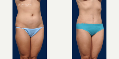 Case 1440 - Woman treated with Tummy Tuck