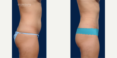 Case 1441 - Woman treated with Tummy Tuck