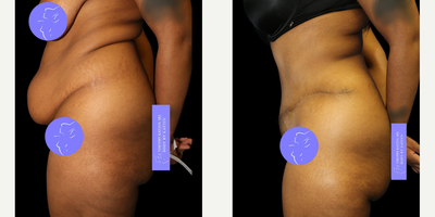 Case 1442 - 25-34 year old woman treated with Tummy Tuck