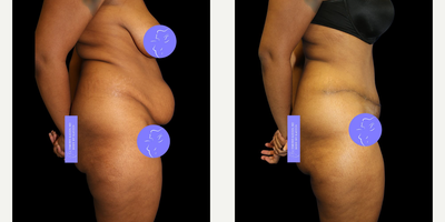 Case 1443 - 25-34 year old woman treated with Tummy Tuck