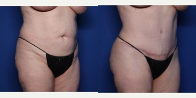 Case 1444 - 55-64 year old woman treated with Tummy Tuck