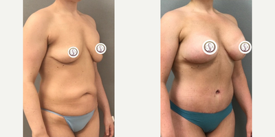 Case 1445 - Woman treated with Breast Augmentation, Tummy Tuck