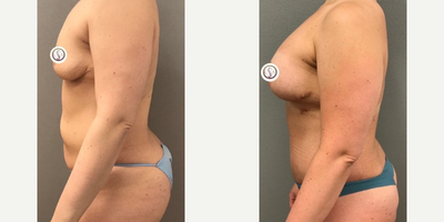 Case 1446 - Woman treated with Breast Augmentation, Tummy Tuck