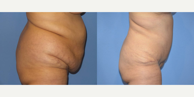 Case 1447 - 55-64 year old woman treated with Tummy Tuck, Liposuction