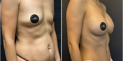 Case 1448 - Woman treated with Breast Augmentation, Breast Implants, Tummy Tuck