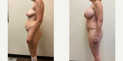 Case 1449 - Woman treated with Breast Augmentation, Tummy Tuck