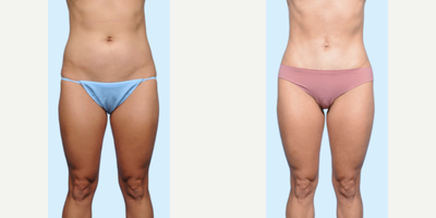 Case 145 - Woman treated with Tummy Tuck