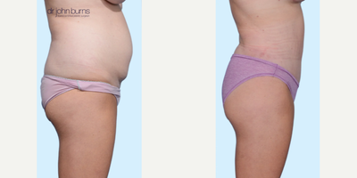 Case 1450 - Woman treated with Tummy Tuck