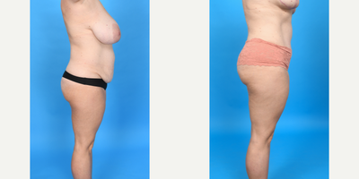 Case 1458 - 45-54 year old woman treated with Diastasis Recti Repair, Drainless Tummy Tuck, Liposculpture, Liposuction, Mommy Makeover, Tume