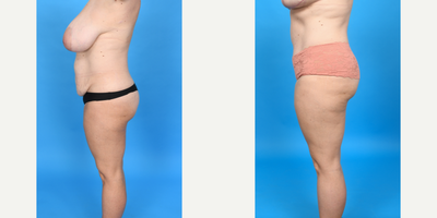 Case 1459 - 45-54 year old woman treated with Diastasis Recti Repair, Drainless Tummy Tuck, Liposculpture, Liposuction, Mommy Makeover, Tume