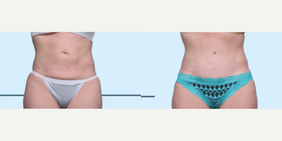 Case 146 - Woman treated with Tummy Tuck