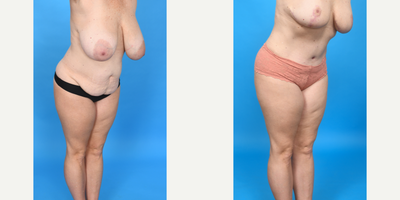 Case 1460 - 45-54 year old woman treated with Diastasis Recti Repair, Drainless Tummy Tuck, Liposculpture, Liposuction, Mommy Makeover, Tume