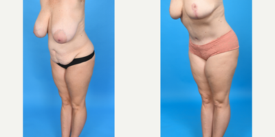 Case 1461 - 45-54 year old woman treated with Diastasis Recti Repair, Drainless Tummy Tuck, Liposculpture, Liposuction, Mommy Makeover, Tume