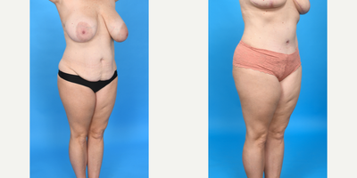 Case 1462 - 45-54 year old woman treated with Diastasis Recti Repair, Drainless Tummy Tuck, Liposculpture, Liposuction, Mommy Makeover, Tume