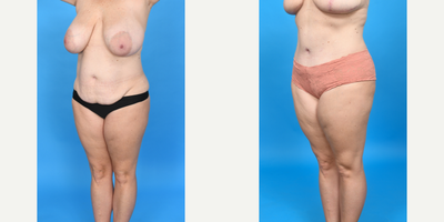 Case 1463 - 45-54 year old woman treated with Diastasis Recti Repair, Drainless Tummy Tuck, Liposculpture, Liposuction, Mommy Makeover, Tume