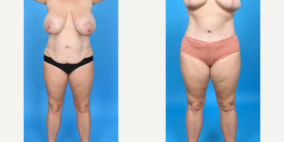 Case 1464 - 45-54 year old woman treated with Diastasis Recti Repair, Drainless Tummy Tuck, Liposculpture, Liposuction, Mommy Makeover, Tume