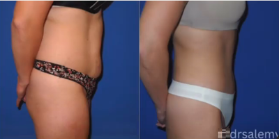 Case 1465 - Woman treated with Tummy Tuck