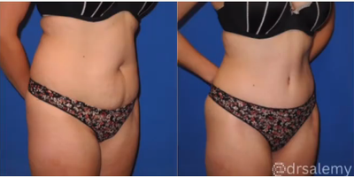 Case 1466 - Woman treated with Tummy Tuck