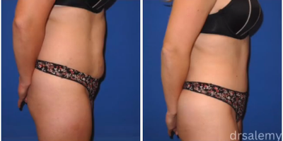 Case 1467 - Woman treated with Tummy Tuck