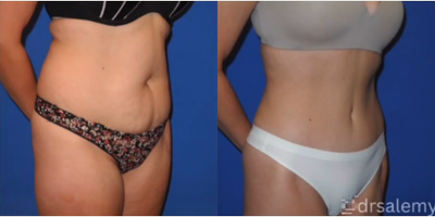 Case 1468 - Woman treated with Tummy Tuck