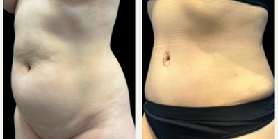 Case 1469 - Woman treated with Tummy Tuck