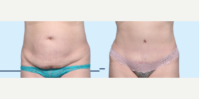 Case 147 - Woman treated with Tummy Tuck