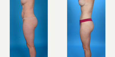 Case 1470 - 35-44 year old woman treated with Abdominal Etching, Tummy Tuck, Tumescent Liposuction, Mini Tummy Tuck, Diastasis Recti Repair,