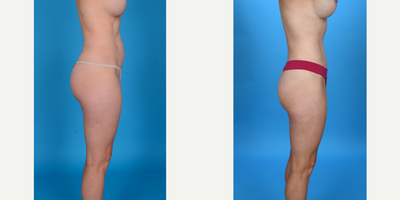 Case 1471 - 35-44 year old woman treated with Abdominal Etching, Tummy Tuck, Tumescent Liposuction, Mini Tummy Tuck, Diastasis Recti Repair,