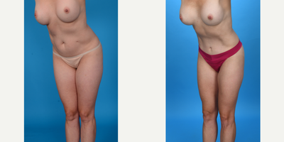 Case 1472 - 35-44 year old woman treated with Abdominal Etching, Tummy Tuck, Tumescent Liposuction, Mini Tummy Tuck, Diastasis Recti Repair,