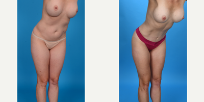 Case 1473 - 35-44 year old woman treated with Abdominal Etching, Tummy Tuck, Tumescent Liposuction, Mini Tummy Tuck, Diastasis Recti Repair,