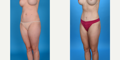 Case 1474 - 35-44 year old woman treated with Abdominal Etching, Tummy Tuck, Tumescent Liposuction, Mini Tummy Tuck, Diastasis Recti Repair,