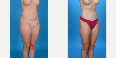 Case 1475 - 35-44 year old woman treated with Abdominal Etching, Tummy Tuck, Tumescent Liposuction, Mini Tummy Tuck, Diastasis Recti Repair,