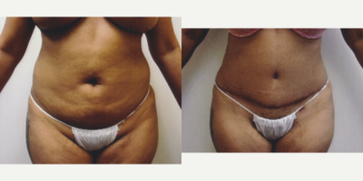 Case 1481 - 25-34 year old woman treated with Tummy Tuck