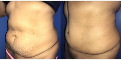 Case 1483 - Woman treated with Tummy Tuck