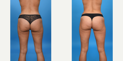 Case 1489 - 35-44 year old woman treated with Abdominal Etching, Diastasis Recti Repair, Liposculpture, Liposuction, Liposuction Revision, M