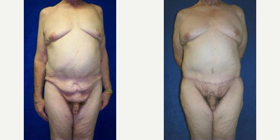 Case 149 - Man treated with Tummy Tuck