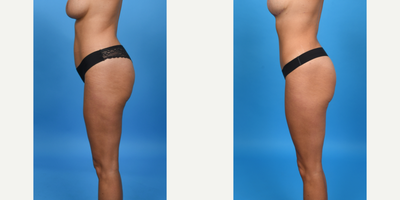 Case 1490 - 35-44 year old woman treated with Abdominal Etching, Diastasis Recti Repair, Liposculpture, Liposuction, Liposuction Revision, M