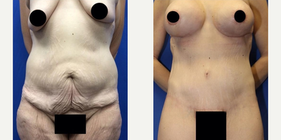 Case 1491 - Tummy Tuck