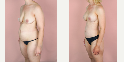 Case 1497 - 35-44 year old woman treated with Mommy Makeover, Breast Augmentation, Tummy Tuck