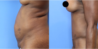 Case 1499 - Woman treated with Tummy Tuck, Liposuction