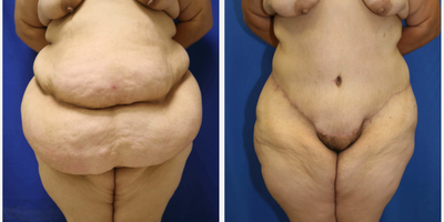 Case 150 - Woman treated with Tummy Tuck