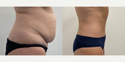 Case 1500 - 35-44 year old woman treated with Tummy Tuck