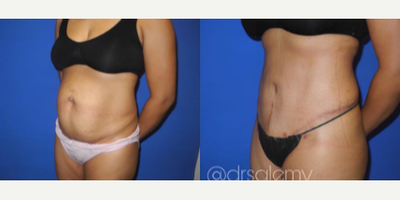 Case 1501 - Woman treated with Tummy Tuck